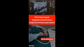 КАТЕТЕРИЗАЦИЯ ПОДКЛЮЧИЧНОЙ ВЕНЫ НАДКЛЮЧИЧНЫМ ДОСТУПОМ ПОД УЗИ