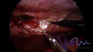 Торакоскопическое лигирование грудного протока у собаки с хилотораксом / Thoracoscopic thoracic duct ligation in a dog with chylothorax