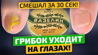 Грибок исчез! Кто придумал мешать вазелин с ... За 2 раза помогло!