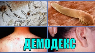 ПОДКОЖНЫЙ КЛЕЩ У ЧЕЛОВЕКА. Демодекс под микроскопом в лаборатории. СИМПТОМЫ КАК ИЗБАВИТЬСЯ