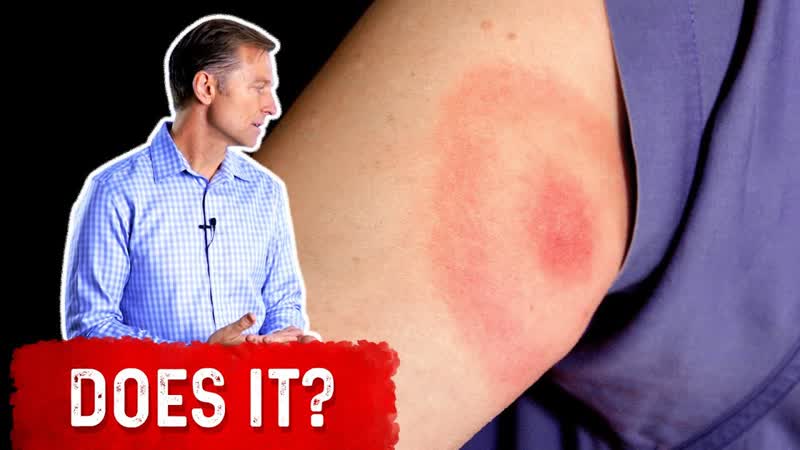 Does the Bullseye Rash Mean Lyme