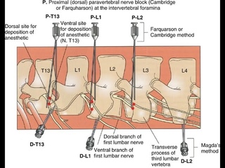 Паравертебральная блокада левого бока у коровы / Paravertebral nerve block of the left flank of a cow