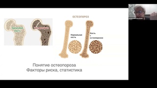 Профилактика остеопороза и роль акушеров // Как сохранить опору в жизни // Взгляд врача гинеколога