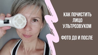 После такой чистки ватный диск черный. Чистка лица ультрозвуком с помощью аппарата Сильварис.