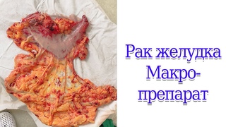 Рак желудка  Макропрепарат #ракжелудка #гистология #анатомия