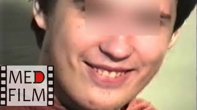 ( R) Гебефренная шизофрения Hebephrenia, Schizophrenia, History