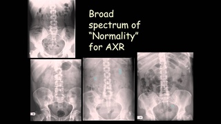 How to talk about the normal abdominal plain X-ray